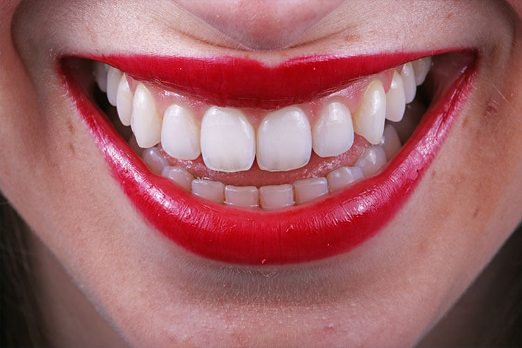 BRANQUEAMENTO DENTÁRIO