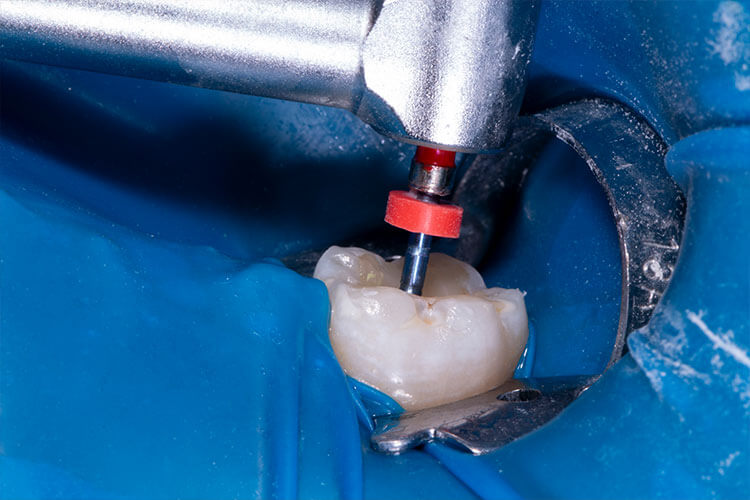 ENDODONTIA